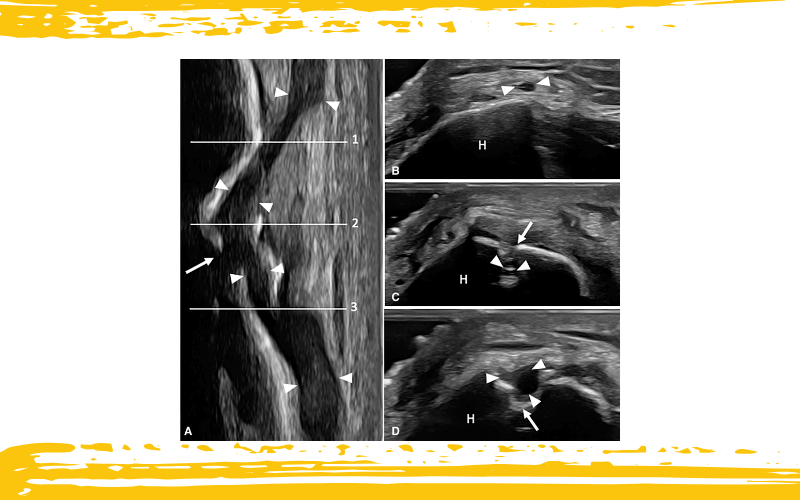 4. Nervio cutaneo posterior antebrazo tempo formacion ecografia.png